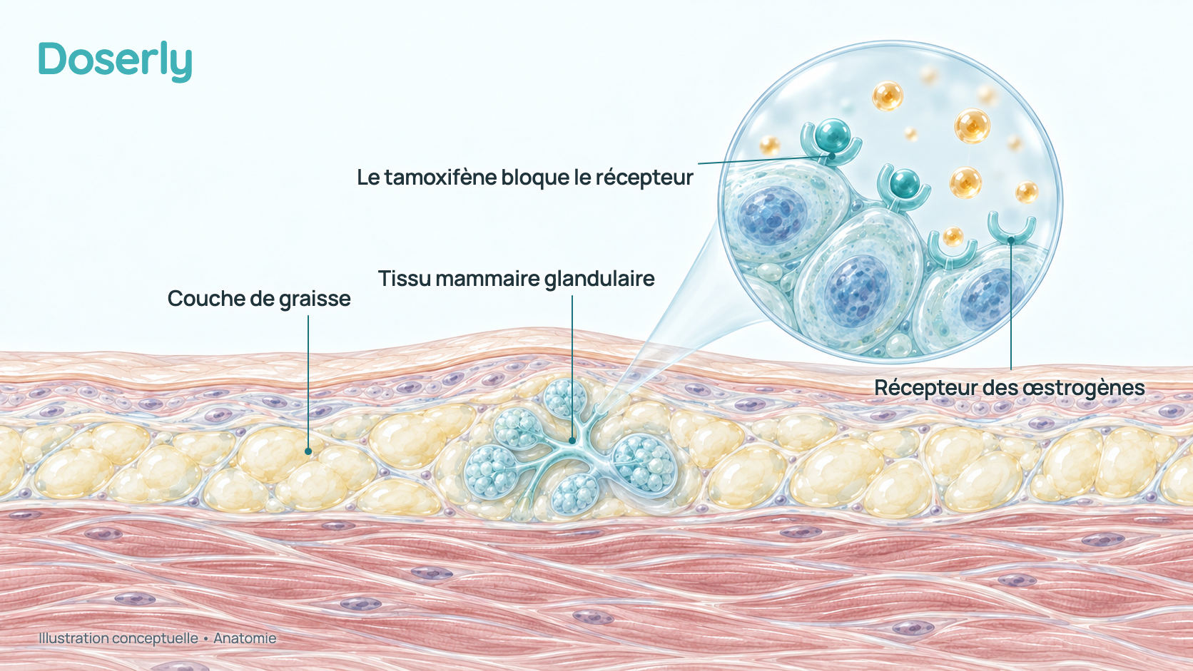 Illustration conceptuelle d’une coupe du tissu du thorax masculin, avec un petit amas de tissu mammaire glandulaire et une vue agrandie de cellules glandulaires dont les récepteurs des œstrogènes sont bloqués par le tamoxifène. Elle montre l’anatomie et l’action d’un médicament, pas des résultats mesurés.