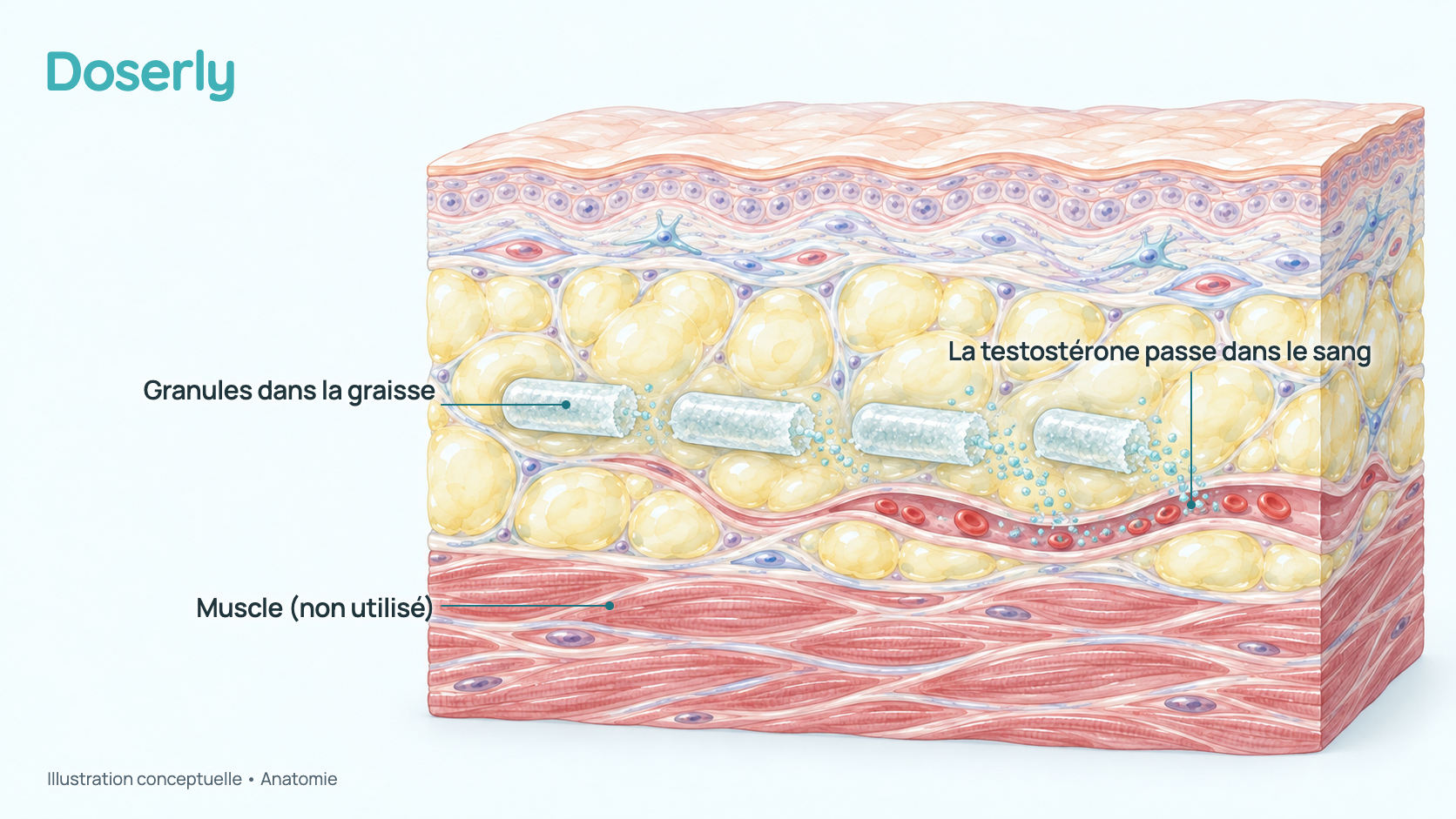 Coupe conceptuelle de la peau, de la graisse et du muscle avec une courte rangée de petits granules cristallins dans la couche de graisse, qui se dissolvent lentement et libèrent de la testostérone vers un petit vaisseau sanguin. Elle montre l’anatomie, pas un effet mesuré du médicament.