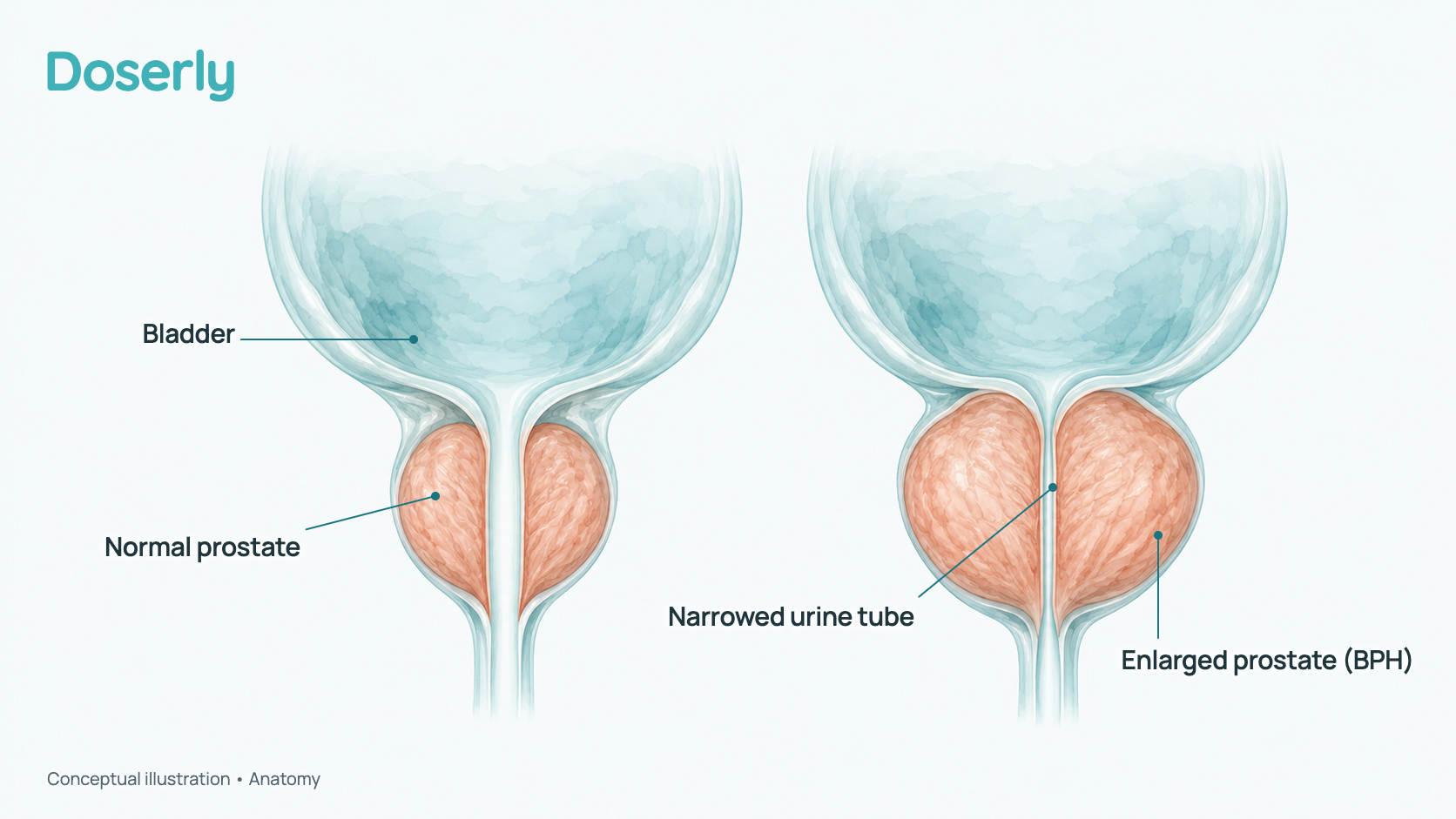 Conceptual illustration of two cut-through prostates below the bladder, one normal-sized with an open urine tube and one enlarged and pressing the tube narrower. It is a schematic, not a measured size.